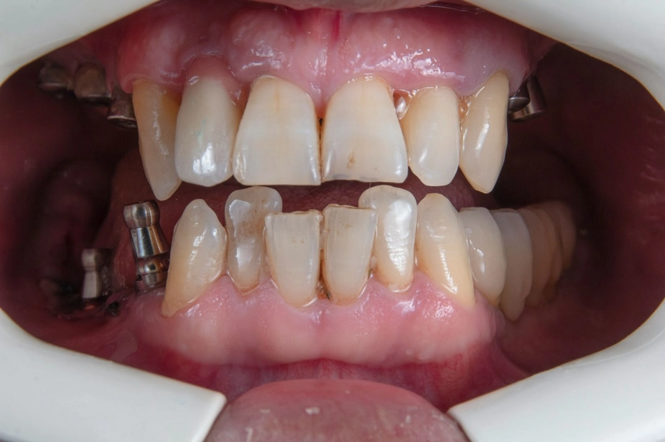 All-on-X dental implants available near Shady Spring, WV