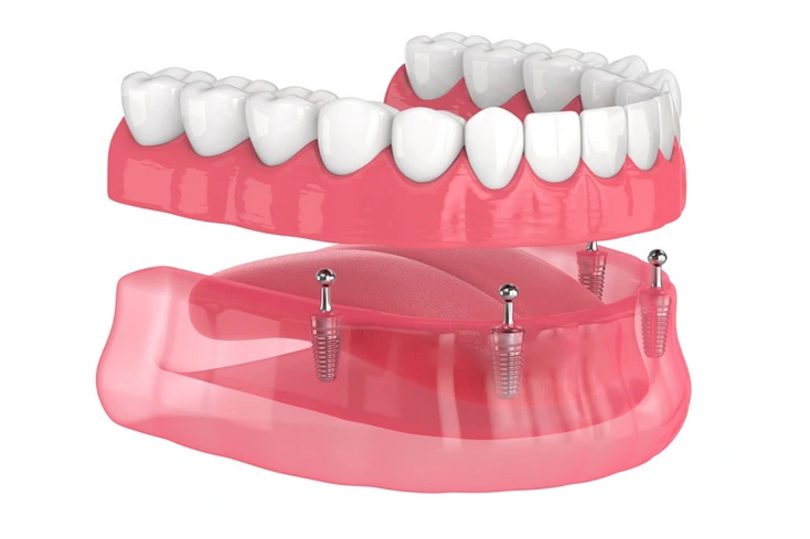 All-on-X dental implants in Shady Spring, Lochgelly, and Bluefield, WV, serving patients in Beckley, Princeton, Lewisburg, Oak Hill, Summersville, Fayetteville, Hinton, WV, Tazewell, Wytheville, Pearisburg, and Narrows, VA.