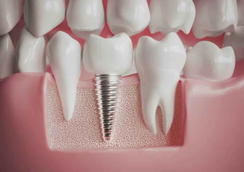 Dental implants in Shady Spring, Lochgelly, and surrounding areas such as Beckley, Princeton, Lewisburg, Oak Hill, Summersville, Fayetteville, and Hinton, WV