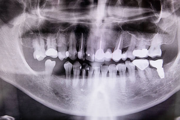 Root Canal and Infection Xray: Our Dentists Explain How to Tell if a Tooth is Infected in Shady Spring and Lochgelly