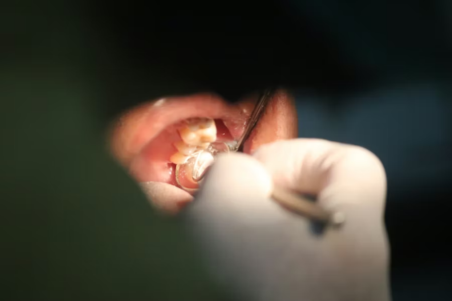 Tooth pain from an extraction in Shady Spring, Lochgelly, and Bluefield, WV.